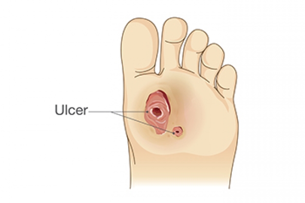 What Is a Diabetic Foot Ulcer?