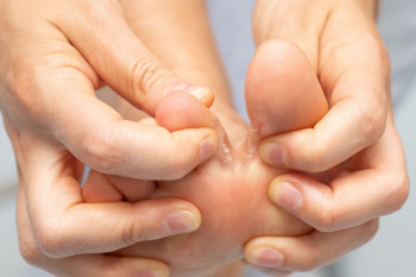 Recognizing the Symptoms of Athlete&#039;s Foot