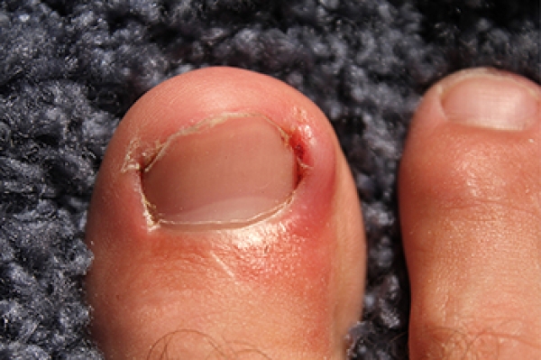 Toenail Problems