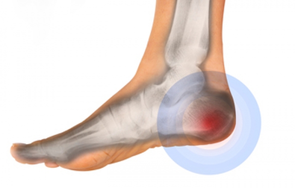 There Are Several Forms of Heel Pain