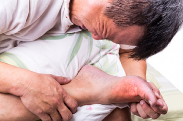 How Do Gout Attacks Occur?