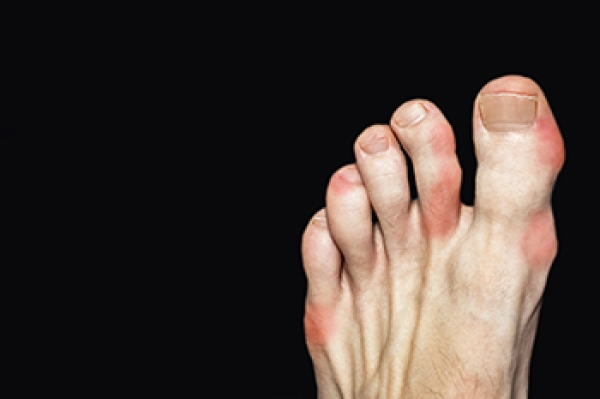 Gout and Dietary Considerations