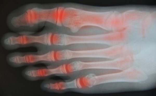 Big Toe Arthritis Relief