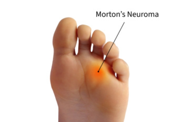 Treatment for Morton&#039;s Neuroma