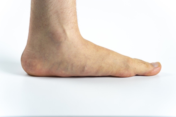 Early Intervention for Flat Feet